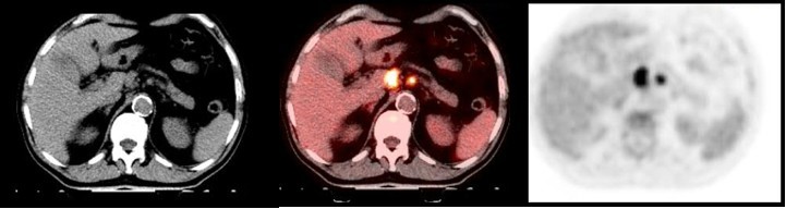 Bild: PET/CT bei einem Ösophagus-Karzinom (Speiseröhrenkrebs): links das CT, rechts das PET, in der Mitte die verschmolzenen Bilder – das PET/CT. Der leuchtende Punkt links ist der Ursprungstumor, der kleinere Punkt rechts eine Metastase in einem Lymphknoten.
