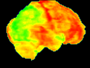 Cerebral metabolism in Alzheimer's disease; The green areas indicate the reduced metabolism