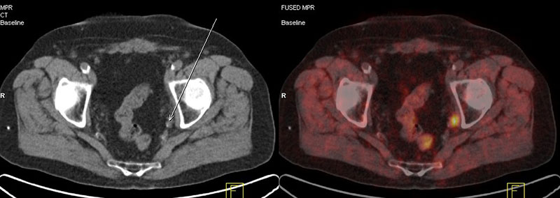 Lymphknotenmetastasen im Becken bei einem Patienten mit Prostata-Karzinom
