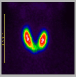 Figure: Thyroid scintigraphy displays the butterfly shape of the thyroid gland